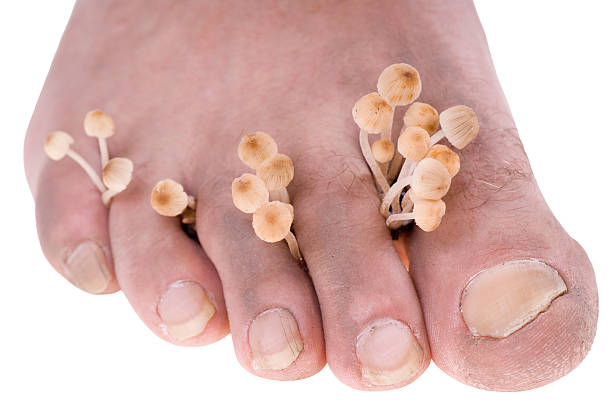 mycosis - fungus toenail human foot onychomycosis stock-fotos und bilder