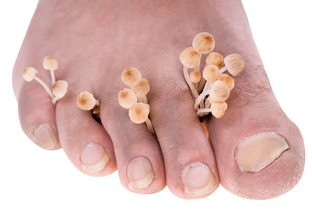 mycosis - fungus toenail human foot onychomycosis ストックフォトと画像