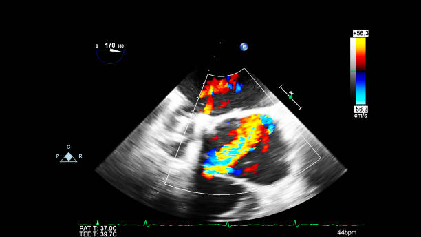 Image of the heart during transesophageal ultrasound. Image of the heart during transesophageal ultrasound with Doppler mode. pulmonary artery stock pictures, royalty-free photos & images