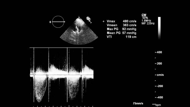 経食道超音波検査中の心臓の画像。 - pulmonary valve ストックフォトと画像