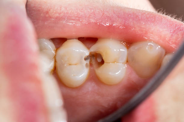 istock Caries and tooth disease. Filling with a dental composite photopolymer material using Rubber Dam. The concept of dental treatment in the dental clinic 1195259169