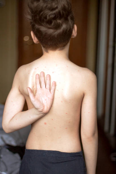 istock Poor boy with chickenpox. Sad little boy itching the body. Chickenpox rash 1195523367