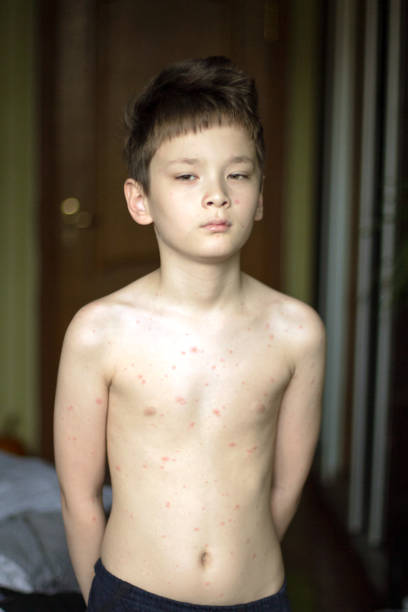 istock Poor boy with chickenpox. Sad little boy itching the body. Chickenpox rash 1195523369