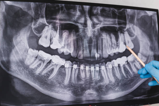 istock Doctor points to cured filled tooth in dental x-ray 1195541907