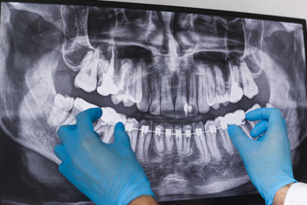 istock Doctor points to braces in dental x-ray 1195541910