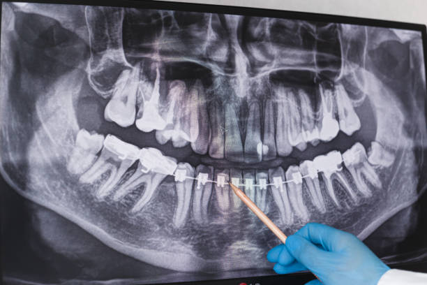 istock Doctor points to braces in dental x-ray 1195541911