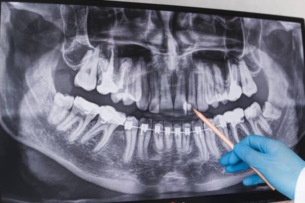 istock Doctor points to cured filled tooth in dental x-ray 1195541914