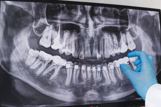 istock Doctor points to braces in dental x-ray 1195541915