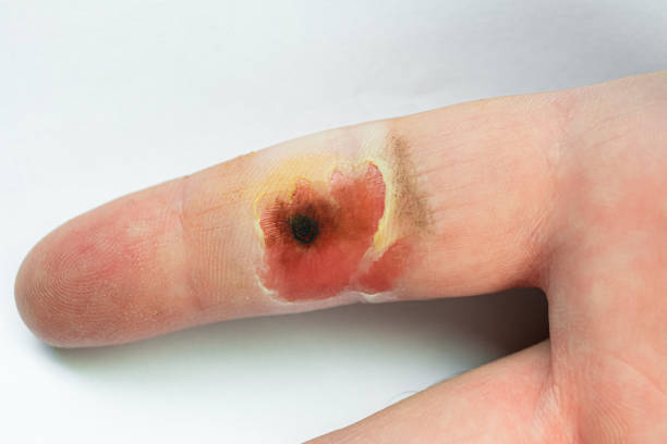 queimadura química na superfície do dedo humano. pele danificada por ácidos e alcalinos. - torned - fotografias e filmes do acervo