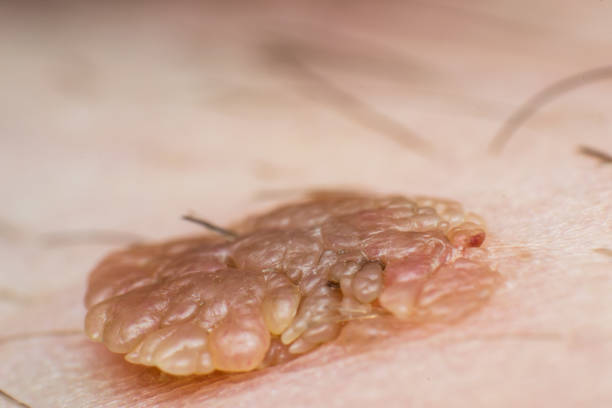 foto macro de una verruga de la piel, infección por el virus del papiloma - fotos de virus papiloma humano fotografías e imágenes de stock