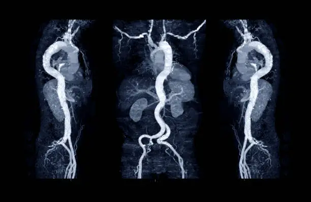 Photo of Collection of CTA whole aorta with curve MPR technique showing abdominal aorta and left, right iliac artery showing aortic dissection .