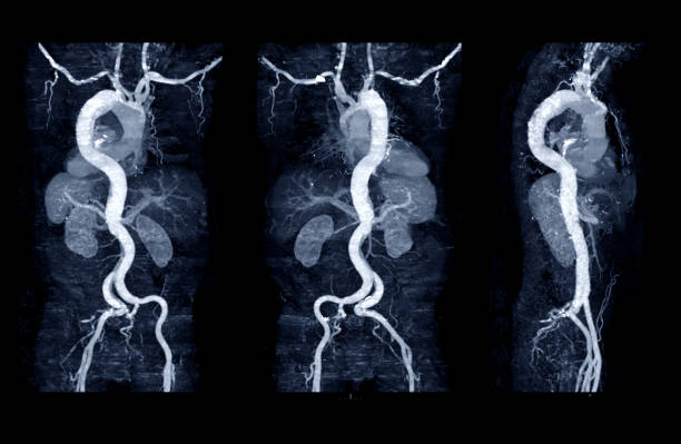 collezione di aorta intera cta con tecnica mpr curva che mostra aorta addominale e arteria iliaca sinistra destra che mostra dissezione aortica . - aorta foto e immagini stock