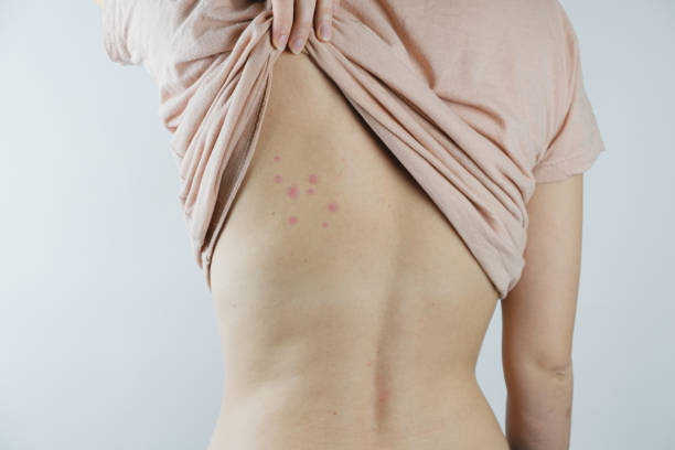 Damaged skin on female's back. Bedbug bites, moosquito bites or skin disease on human body bug bite photos stock pictures, royalty-free photos & images
