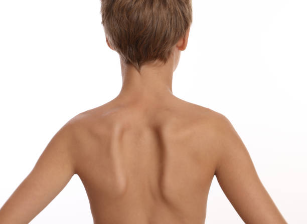 不均一な肩甲骨を持つ子供:脊柱側弯症、運動、治療 - scoliosis ストックフォトと画像