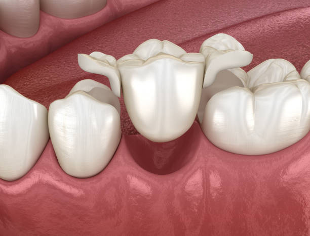 istock Maryland bridge made from ceramic, premolar tooth recovery. Medically accurate 3D illustration of dental concept 1195846431