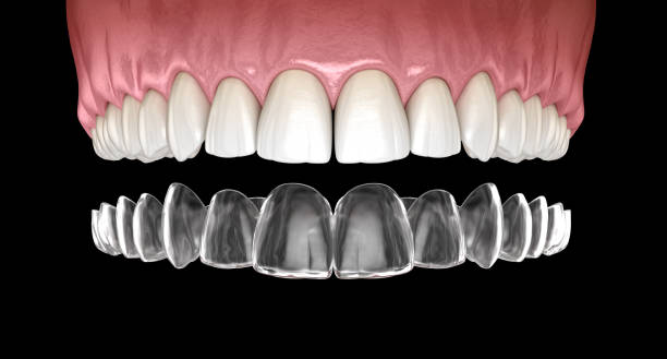 parentesi graffe invisalign o fermo invisibile. illustrazione 3d dentale medicalmente accurata - straightener foto e immagini stock