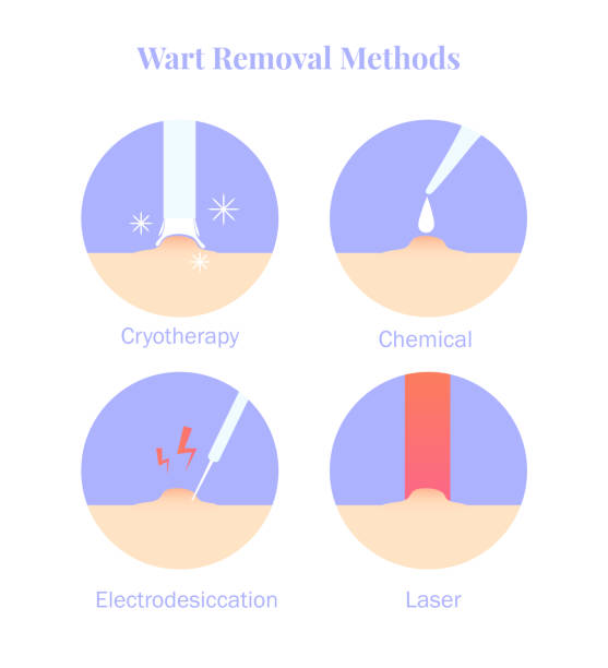 illustrazioni stock, clip art, cartoni animati e icone di tendenza di metodi di rimozione delle verruche infografiche. crioterapia, elettrodetica, rimozione chimica e laser. - neo