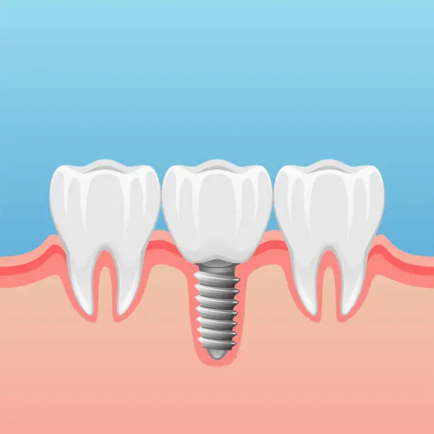 Vector illustration of Teeth implant