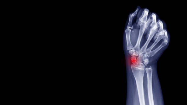 film röntgen-handgelenk-röntgenzeigt zeigen karpalknochen gebrochen (scaphoid fraktur) von stürzen. highlight auf kaputter stelle und schmerzhaftem bereich.  konzept der medizinischen bildgebung und orthopädischen technologie - handgelenk stock-fotos und bilder