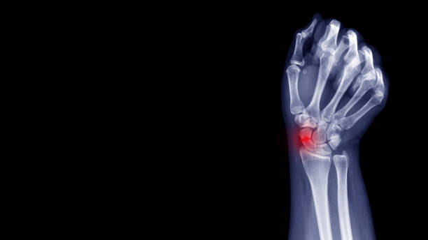 Film X-ray wrist radiograph show carpal bone broken (scaphoid fracture) from falling. Highlight on broken site and painful area.  Medical imaging and orthopedic technology concept Scaphoid bone fracture Wrist stock pictures, royalty-free photos & images