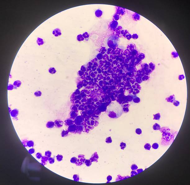 istock Group of inflammation cells ascitic fluid sample laboratory concept. 1196148101