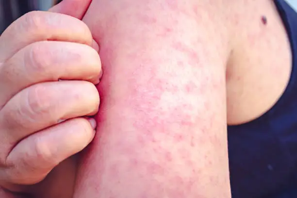 Measles, Women scratch the upper arm with one hand due to the numerous red pruritus., Measles is a disease that can spread easily.