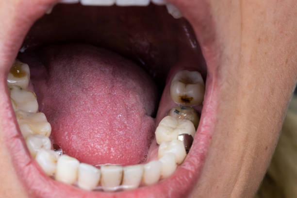 istock Tooth decay with broken crowns and fillers 1196225763
