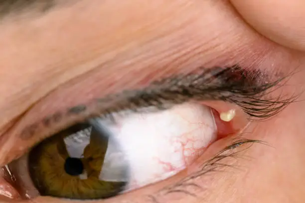 Eye infection disease known as stye