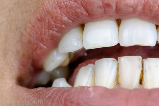 primer plano de los dientes manchados por fumar y beber café - discolored fotografías e imágenes de stock