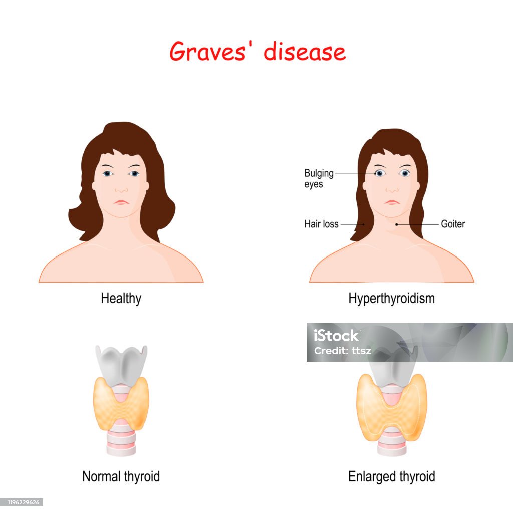 Ziekte Van Graves Toxische Diffuse Struma Stockvectorkunst En Meer ziekte-van-graves-toxische-diffuse-struma-stockvectorkunst-en-meer