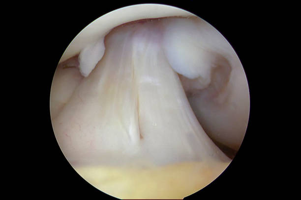 arthroskopische ansicht des normal aussehenden vorderen kreuzbandes (acl) des rechten knies eines erwachsenen menschlichen männchens - cruciate ligament stock-fotos und bilder