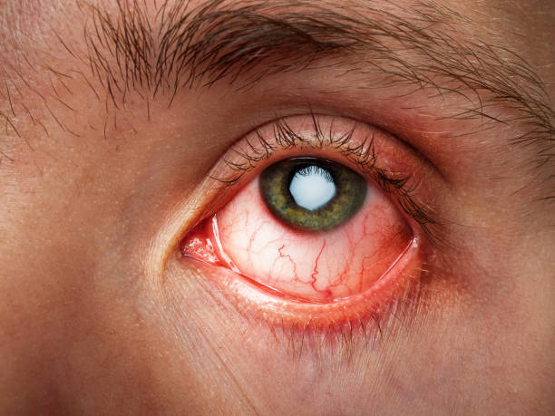 conjunctival inflammation stock photo