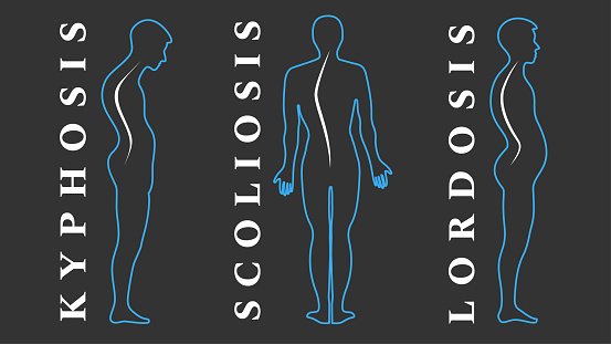 Diseases of the spine. Scoliosis, lordosis, kyphosis. Body posture defects. Back curvature. Spinal deformity types. Medical disease infographic. Diagnostic symptom. Vector illustration