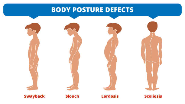 illustrazioni stock, clip art, cartoni animati e icone di tendenza di malattie della colonna vertebrale. scoliosi, lordosi, ondeggiare, slouch. difetti della postura del corpo. tipi di deformità spinale. infografica sulle malattie mediche. sintomo diagnostico. ragazzi silhouette. illustrazione vettoriale. - slouch hat