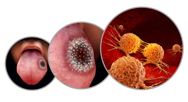 Tongue Cancer Tongue cancer medical concept or squamous cell carcinoma as malignant tumor disease in the mouth with 3D illustration elements. squamous cell carcinoma photos stock pictures, royalty-free photos & images