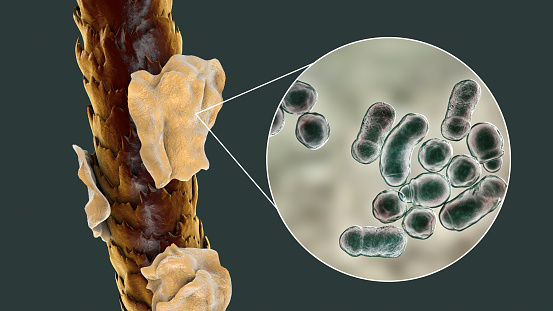 Human hair with dandruff and close-up view of microscopic fungi Malassezia furfur that cause dandruff and seborrhoeic dermatitis, 3D illustration