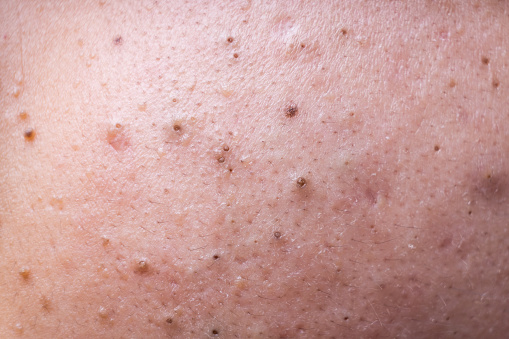 Ugly pimples blackheads on face of teenager