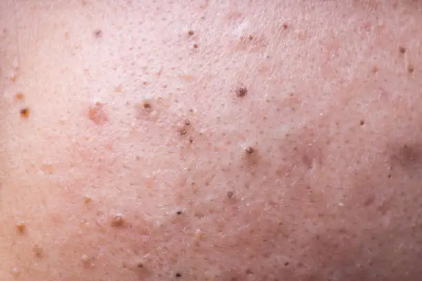 Ugly pimples blackheads on face of teenager neglected of facecare