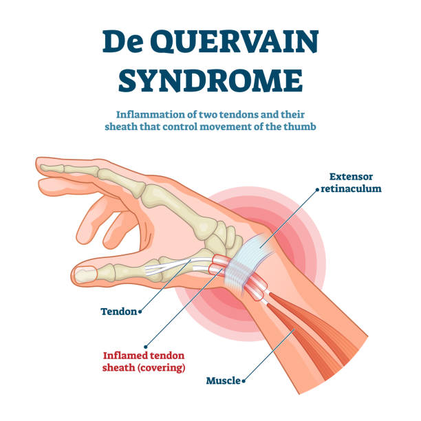 ilustraciones, imágenes clip art, dibujos animados e iconos de stock de ilustración vectorial del síndrome de de quervain. esquema de inflamación del pulgar etiquetado - muñeca articulación