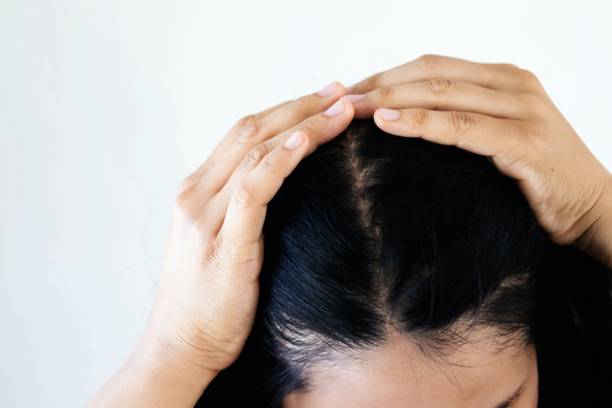 Women's hair loss is caused by stress and allergic to shampoos. stock photo