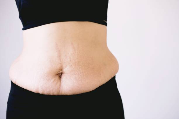 Stretch marks caused by pregnancy weight gain stock photo