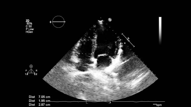 изображение сердца во время трансезофагеального ультразвука. - pulmonary valve стоковые фото и изображения