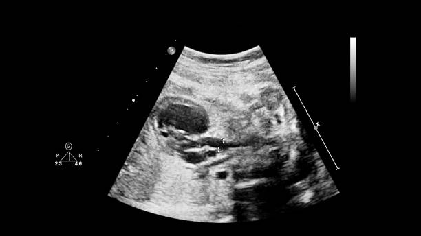 胎児心エコー検査を伴う超音波スクリーン。 - pulmonary valve ストックフォトと画像