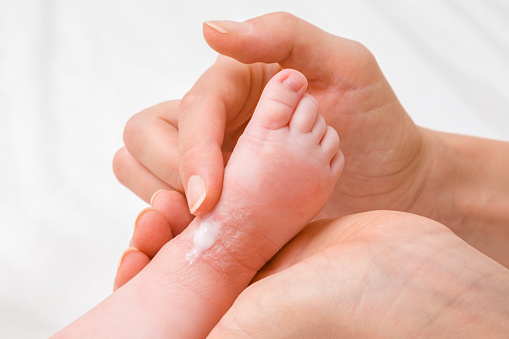Mujer mano sosteniendo la pierna del bebé. Madre aplicando cuidadosamente pomada médica. Alergia a la piel seca roja de la leche fórmula u otros alimentos. Preocupa ción por el cuerpo del bebé. Closeup. photo
