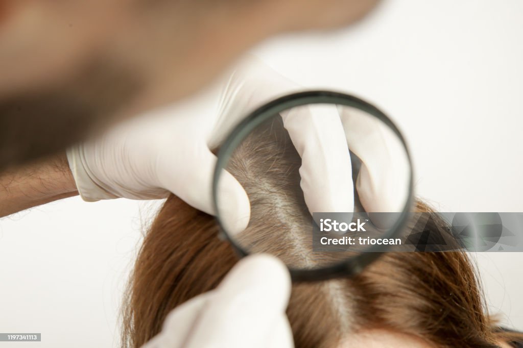Arzt untersucht Frauen Haar Kopfhaut, Kopfhaut Ekzeme, Dermatitis, Psoriasis, Haarausfall, Schuppen oder trockene Kopfhaut Problem - Lizenzfrei Haar Stock-Foto