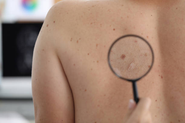istock Macro shot of doctor checking mole 1197459563