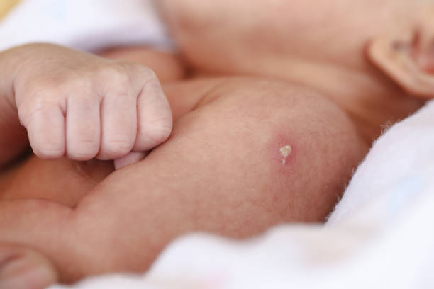 primo piano di reazione dei neonati con vaccinazione bacillus calmette guerin o bcg. - bacillus subtilis foto e immagini stock
