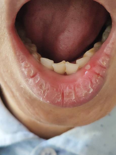 mouth ulcer or canker sore or aphthous stomatitis or aphthous ulcer