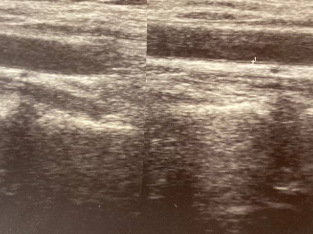 istock Vascular Ultrasound of abdominal aorta 1197636920