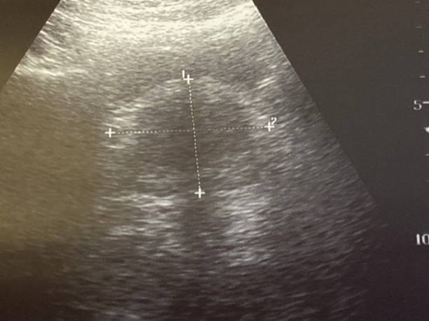 image d'ultrason de la prostate humaine - prostate gland photos et images de collection
